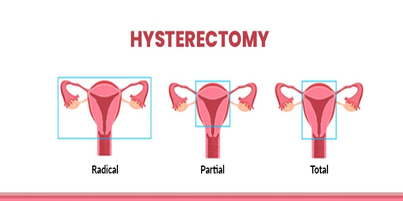 hysterectomy surgery & treatment procedure
