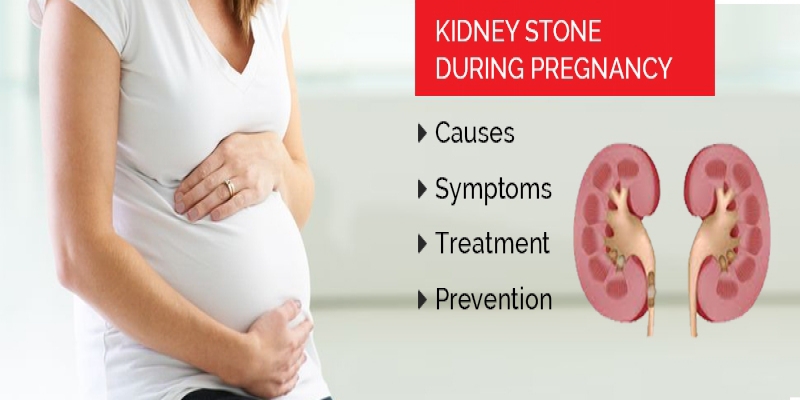 kidney stone during pregnancy