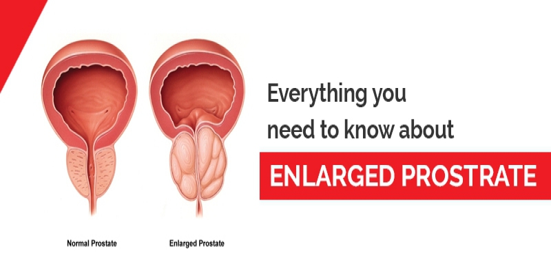 What are the symptoms of an enlarged prostate