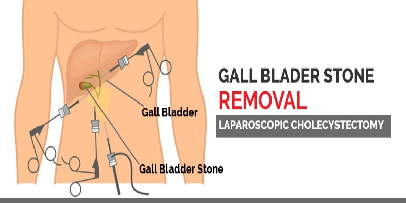 Know About Gallbladder Stones