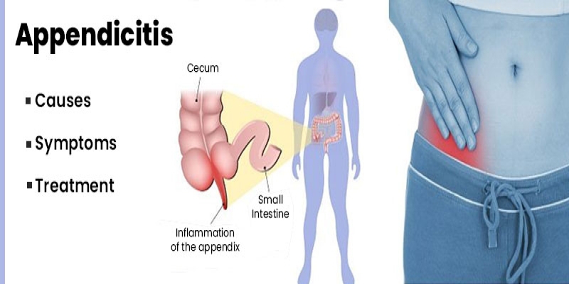 Some Facts About Appendicitis That You Need to Know
