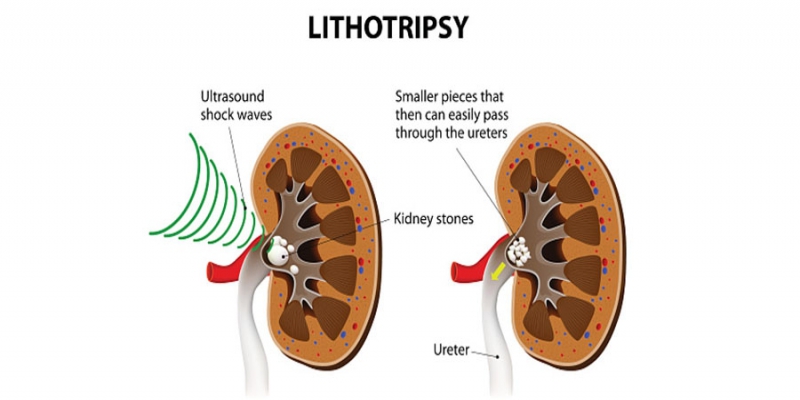 Lithotripsy Treatment for Kidney Stone : Purpose, Procedure & Risks