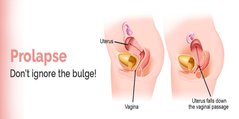 Prolapse – Don’t Ignore The Bulge !