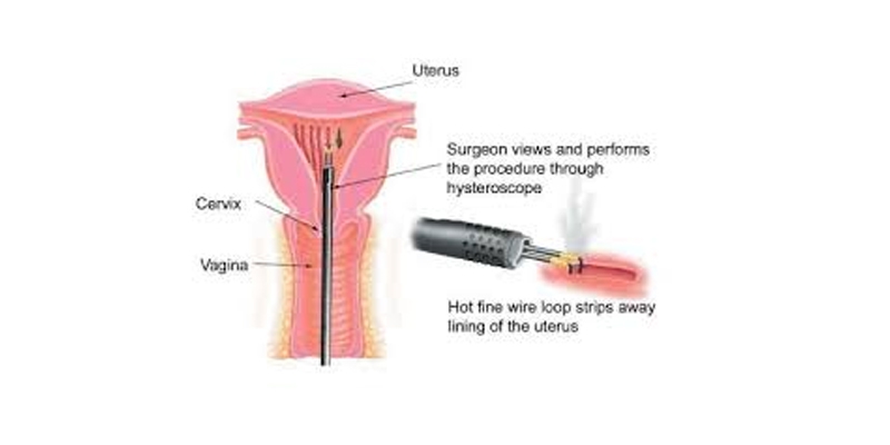 Transcervical Resection of the Endometrium