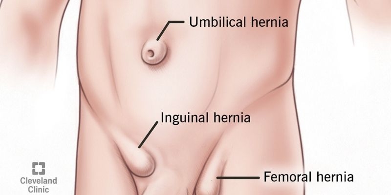 When do you know when it’s Hernia?