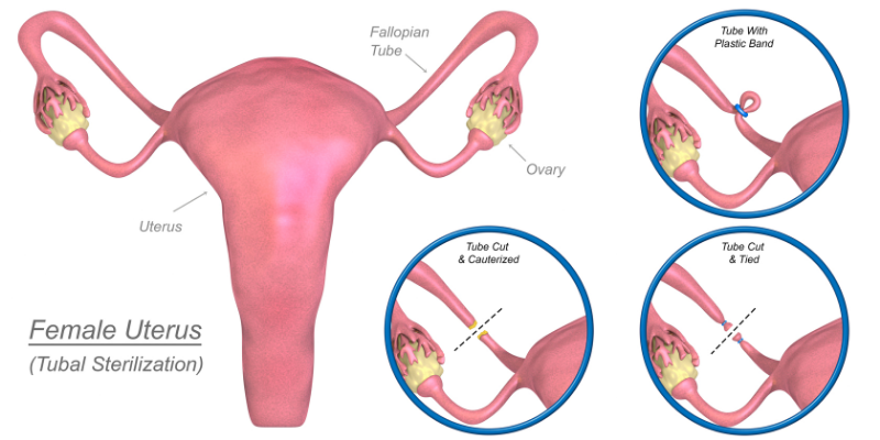 What is the procedure for female sterilization?