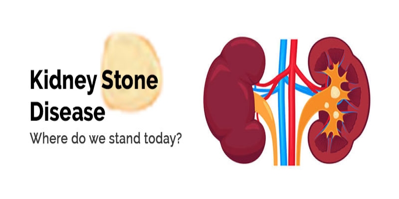 Kidney Stone Disease – Where Do We Stand Today?