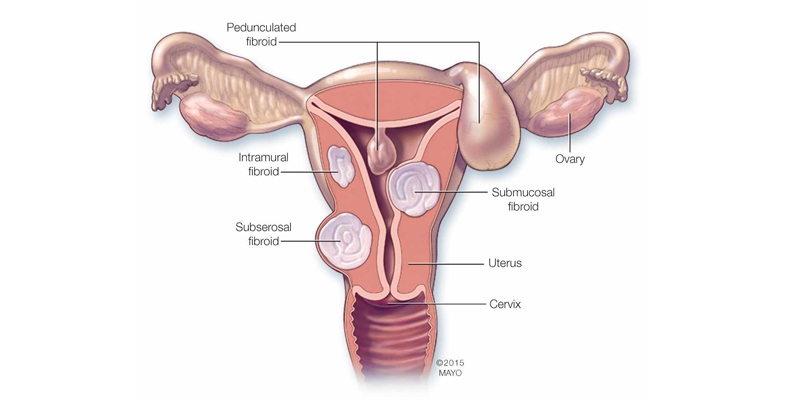 Uterine Fibroids