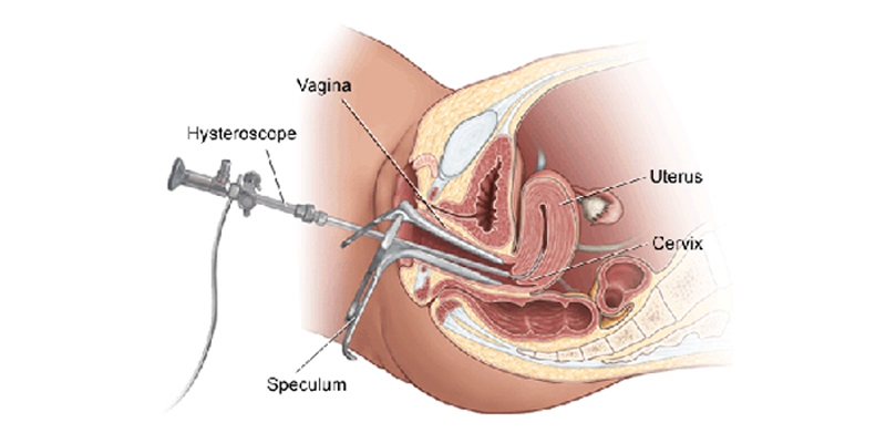 Removal of Uterus