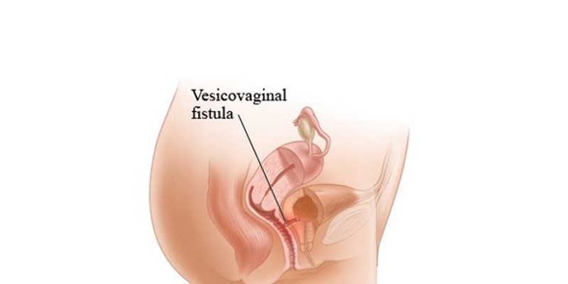  Vesico Vaginal Fistula