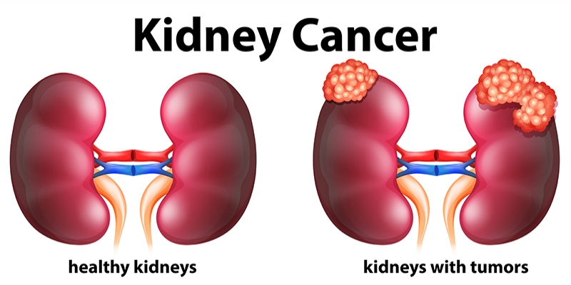 Kidney Cancer - Causes, Symptoms, Risks Factors and More
